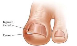 Why do toenails curl?